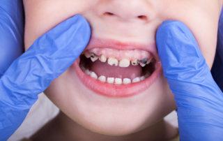 Preventing Infant Tooth Decay