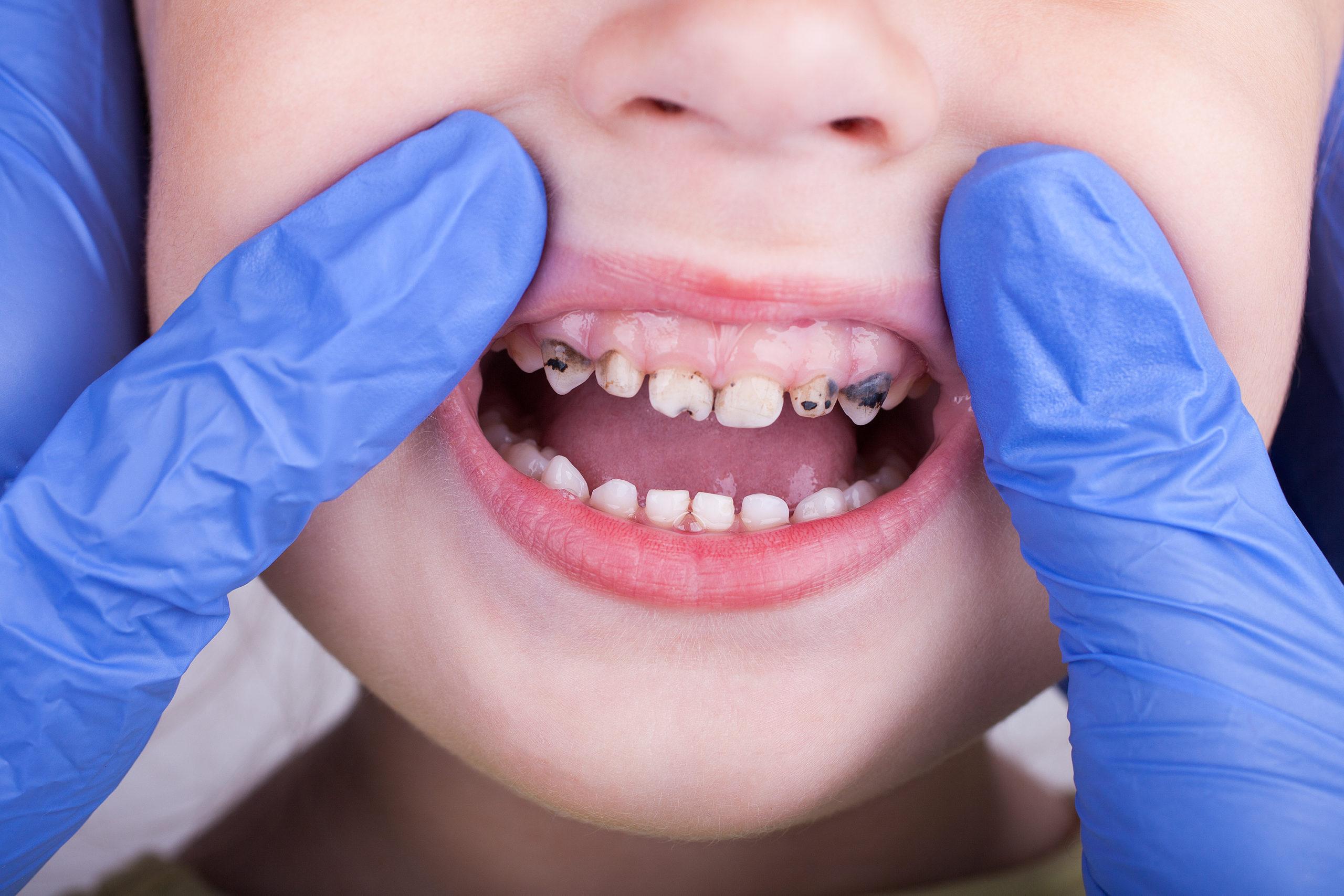 Preventing Infant Tooth Decay