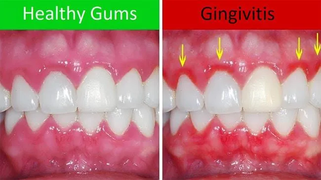 Eumundi Dental Gum Disease Fact Sheet