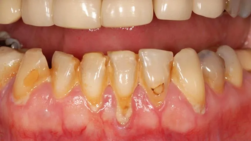 Eumundi Dental Gum Disease Fact Sheet
