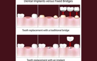 Options For Missing Tooth Replacement