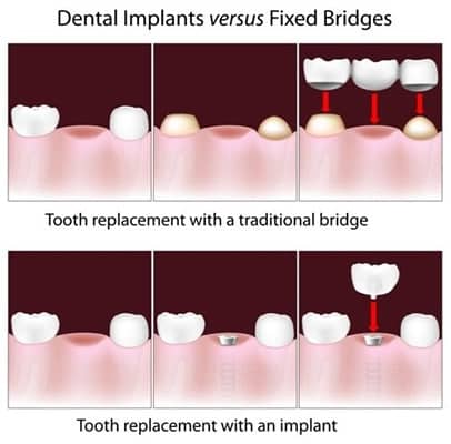 Options for replacing a missing tooth
