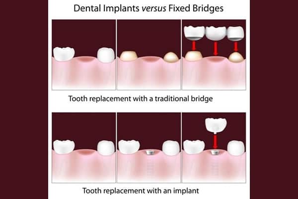 Options For Missing Tooth Replacement